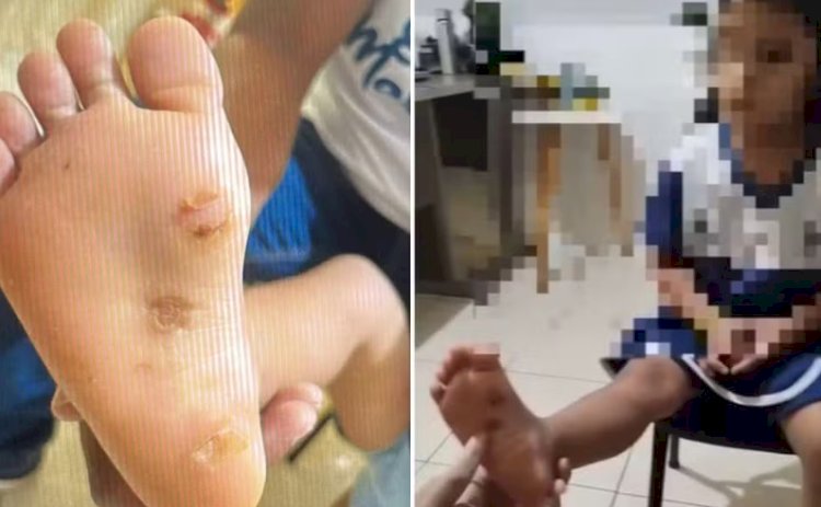 Mãe e padrasto são presos suspeitos de torturar e queimar com isqueiro menina de 4 anos